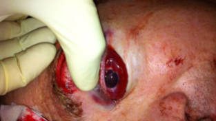 Arvid Horn (39) fra Kopervik mistet øyet første nyttårsdag 2014 da han skulle rydde bort fyrverkeriet. FOTO: Privat