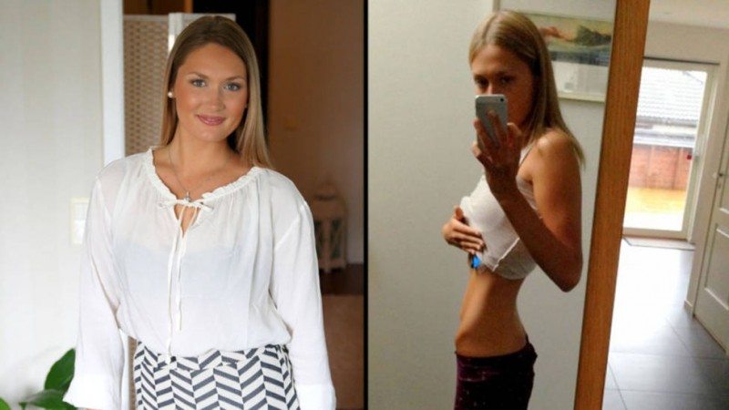 Marianne Naustvik spiseforstyrrelser